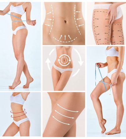 Liposuction