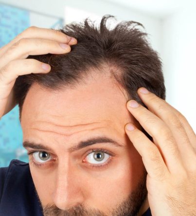 Hair Transplantation